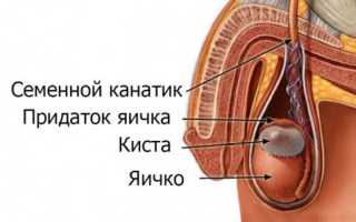 Киста яичника у мужчин последствия