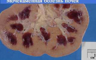Какой алкоголь можно при мочекаменной болезни