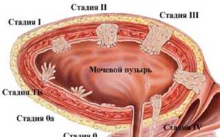 Лечение грибка в урологии