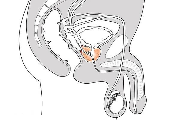 adenoma-prostaty-10