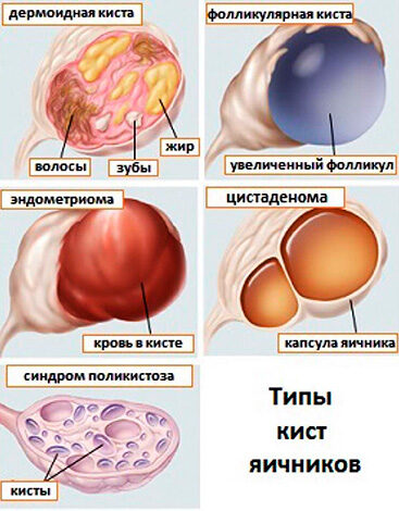 bolit-kista-yaichnika-2